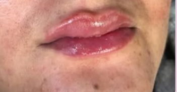 Après Hydrafacial